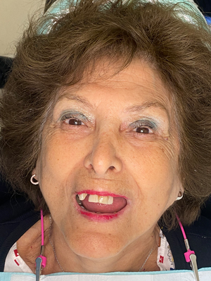 Antes del tratamiento de implantes dentales