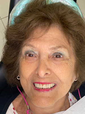 Después del tratamiento de implantes dentales